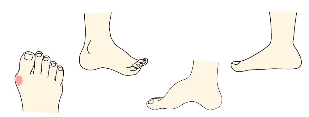 足のアライメント異常　症例画像